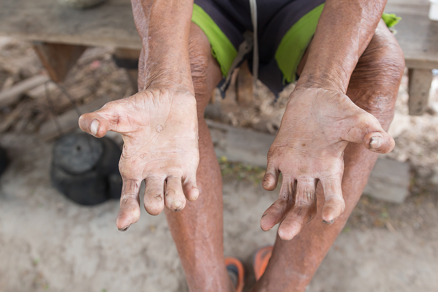Chapter 5:  Jesus Heals a Man with Leprosy